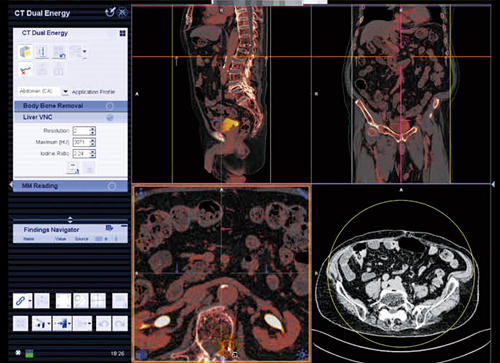 図9　syngo Dual Energy Liver VNC解析