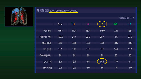 図7　症例4：Pulmo 3Dによる肺気腫の定量化