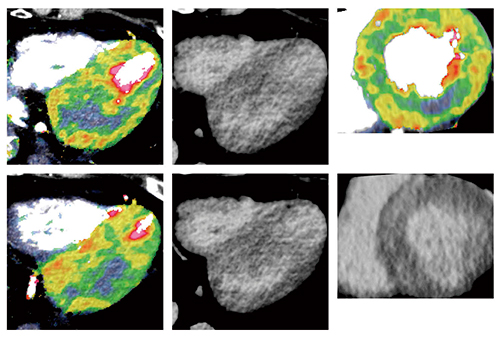 図4　症例2：Voxel-wise MBF mapと遅延造影CT（CTDE）