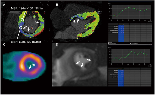 図17　心筋CT Perfusionの定量評価
