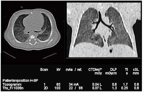 図18　Case11：70kVのSedation Free CT（生後32日，新生児）