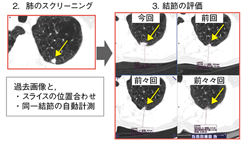 図6　症例4：Lung CAREによる結節の評価