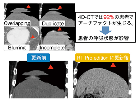 図3　アーチファクトの改善が見られたRT Pro editionでの4D-CT（右下）