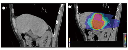 図6　4D-CTによる線量評価