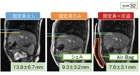 図8　Air-Bag Systemによる呼吸性移動の低減