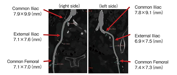 図2　デバイスアクセスルートの評価（腸骨～大腿動脈）