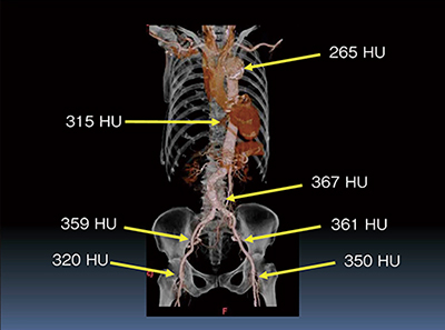 図4　低造影剤量撮影におけるCT値