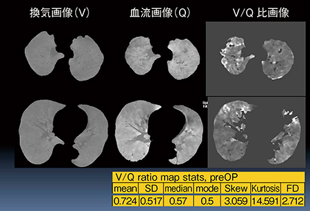 図5　位置合わせが中等度であった1症例の術前V/Q比画像と統計指標（86歳，男性，肺中分化型扁平上皮癌症例）
