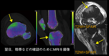 図2　症例2：DE Bone Marrow（挫傷による浮腫の観察）