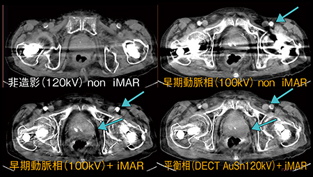 図3　症例3：両側大腿骨頸部骨折へのiMARとHigh-keVの併用処理（形態だけでなく造影効果も確認）