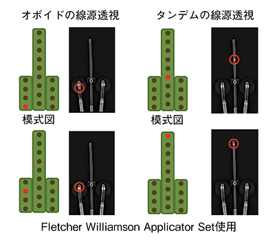 図1　CTの位置決め画像によるアプリケータの線源透視