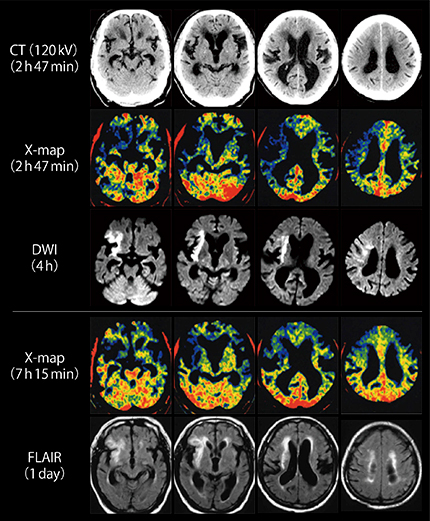 図6　急性期脳梗塞における経時的な画像比較