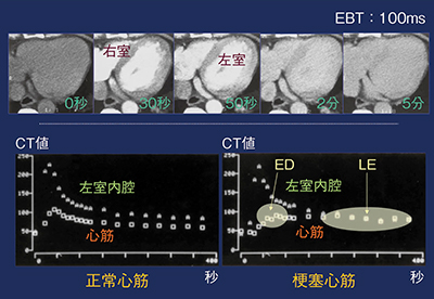図1　電子ビームCTによる心筋の造影効果の検討