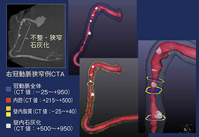 図3　NCVCシステムでの冠動脈の三次元表示