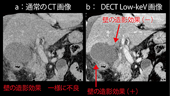 図4　症例4：壊死性胆囊炎による虚血（66歳，女性：冠状断像）