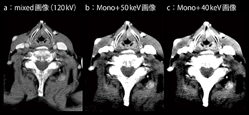 図5　症例5：喉頭がん（50keVでWL/WW最適化）