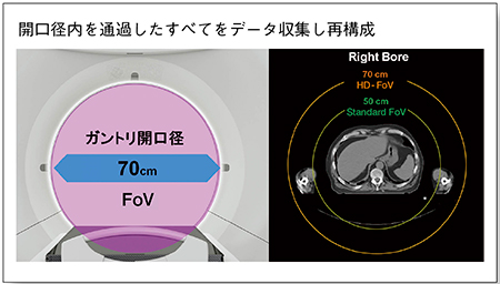 図3　ガントリ開口径と最大FoV が一致 （画像提供：シーメンスヘルスケア株式会社）