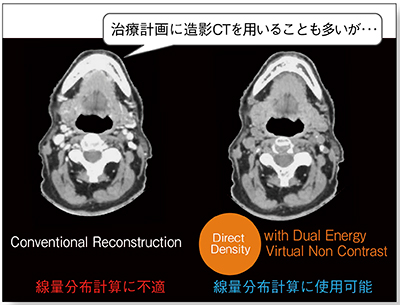 図6　DirectDensityにより造影剤の影響の除去が可能 （画像提供：シーメンスヘルスケア株式会社）