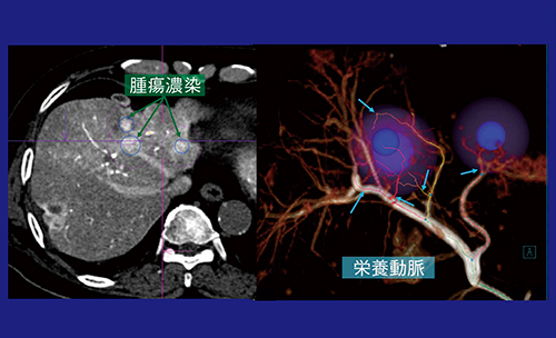 図3　症例1：Embolization Guidanceによる栄養血管の検出