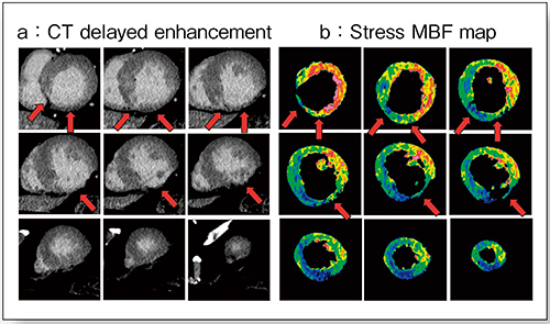 図4　遅延造影CTとMBFマップの併用