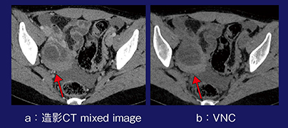 図2　症例2：仮想単純画像による卵巣出血の描出