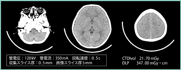 図4　エリアファインダを用いた小児頭部撮影（2歳8か月）