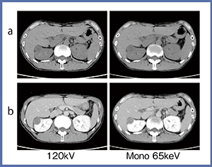 図5　120kV画像と仮想単色X線画像（65keV）との比較