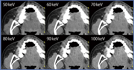 図4　DECTの仮想単色X線画像を用いたメタルアーチファクト低減（50〜100keVでの比較）