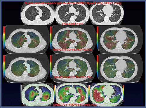 図3　喫煙に伴うCOPD患者におけるSubtraction ADCT（Sub-CT）およびDual Energy