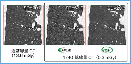 図1　超低線量肺野CT（拡大画像）