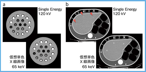 図7　仮想単色X線画像による画質向上