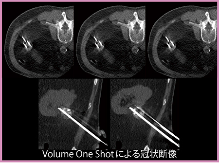 図7　RCC（74歳，男性）に対するオブリーク穿刺