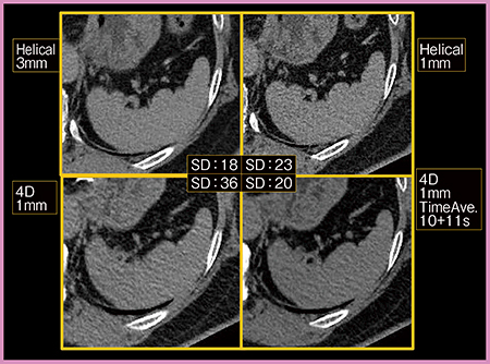 図8　320列ADCTの画質向上