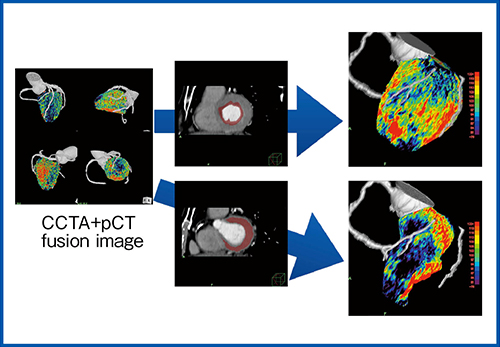 図5　症例2のCCTA＋Dynamic Perfusion解析のフュージョンによる解析1）