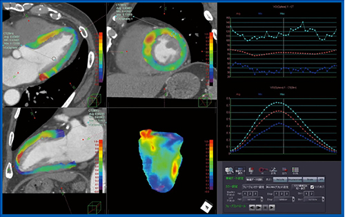 図7　CTストレイン解析