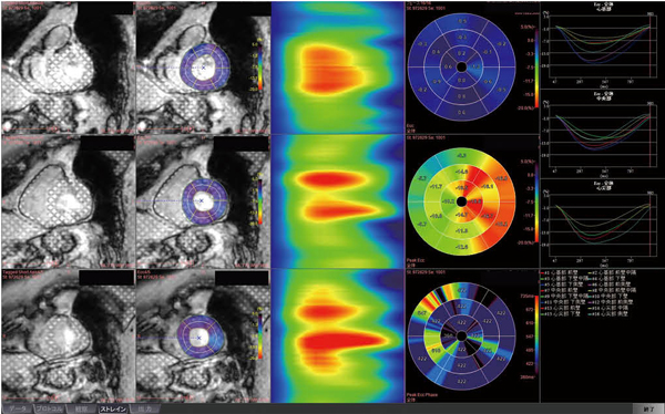 図4　ziostation2の解析結果の画面 各断面でのストレインカーブ、セグメントごとのピークストレインを出したブルズアイ画像などの解析データが表示。この中で必要な画像だけをPACS側に転送する。