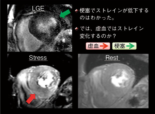 図3　ストレイン解析の虚血への応用