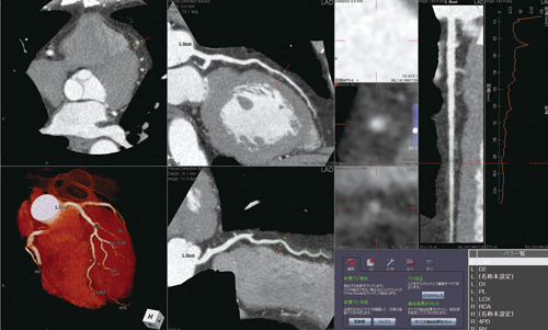 CT冠動脈解析による冠動脈スクリーニング
