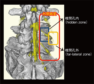 図1　外側病変