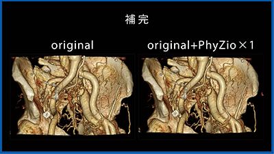 図2　骨盤動静脈奇形（AVF）の4Dイメージ PhyZiodynamicsの1倍補完では、ノイズリダクションによって画質が改善した。