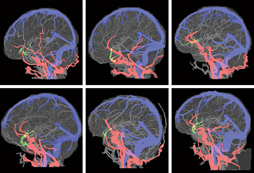 図1　患者間における中枢血管の走行の違い（解剖学的認識アルゴリズム適用）