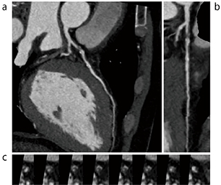 図1　冠動脈解析例（冠動脈狭窄） a：CPR　b：ストレートビュー　c：短軸像