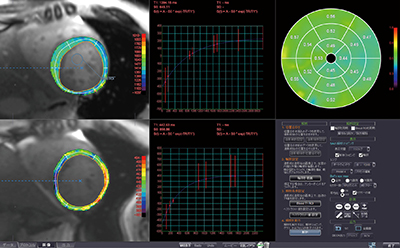 Ziostation2によるMR心筋T1マッピング解析