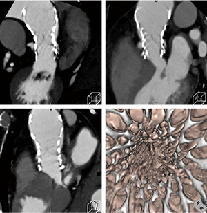 図1　IQonスペクトラルCTとZiostation2によるTAVI弁術後評価