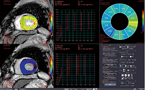 図3　MR心筋T1マッピング