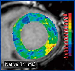 図2　MR心筋T1マッピングによる心筋評価：心ファブリー病