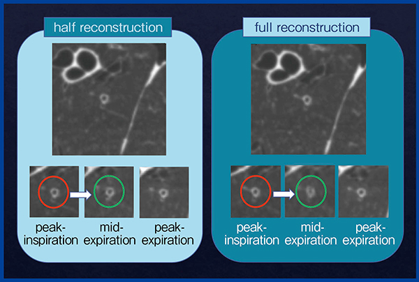 図3　呼吸ダイナミックCTにおけるハーフ再構成とフル再構成の画像比較10）