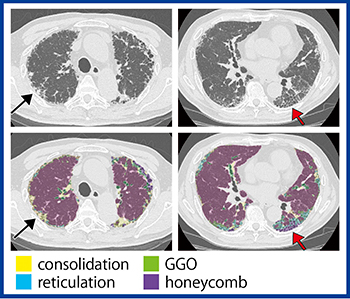 図1　IPFの「QZIP-ILD」による解析結果（症例1）