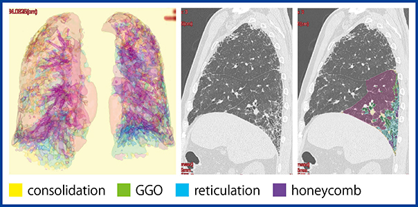 図2　「QZIP-ILD」による肺葉ごとの解析結果（症例1）