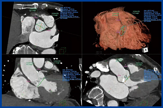 図3　大動脈弁狭窄での「TAVR術前プランニング」による解析